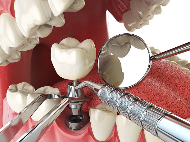 Best Emergency Wisdom Teeth Removal in Lake Vla, IL